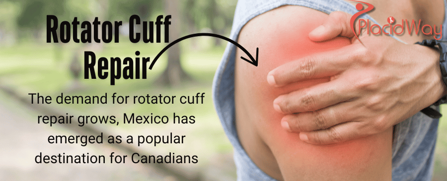 The Rising Demand for Rotator Cuff Repair in Mexico: A Guide for Canadians