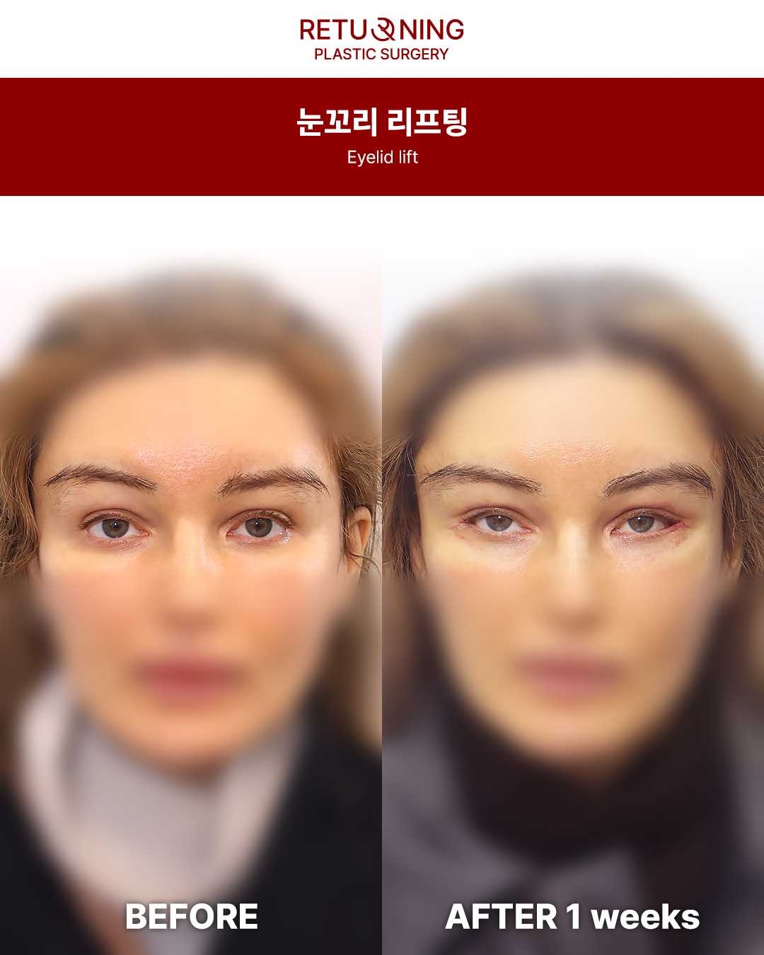 复原整形手术 眼睑手术前后对比图