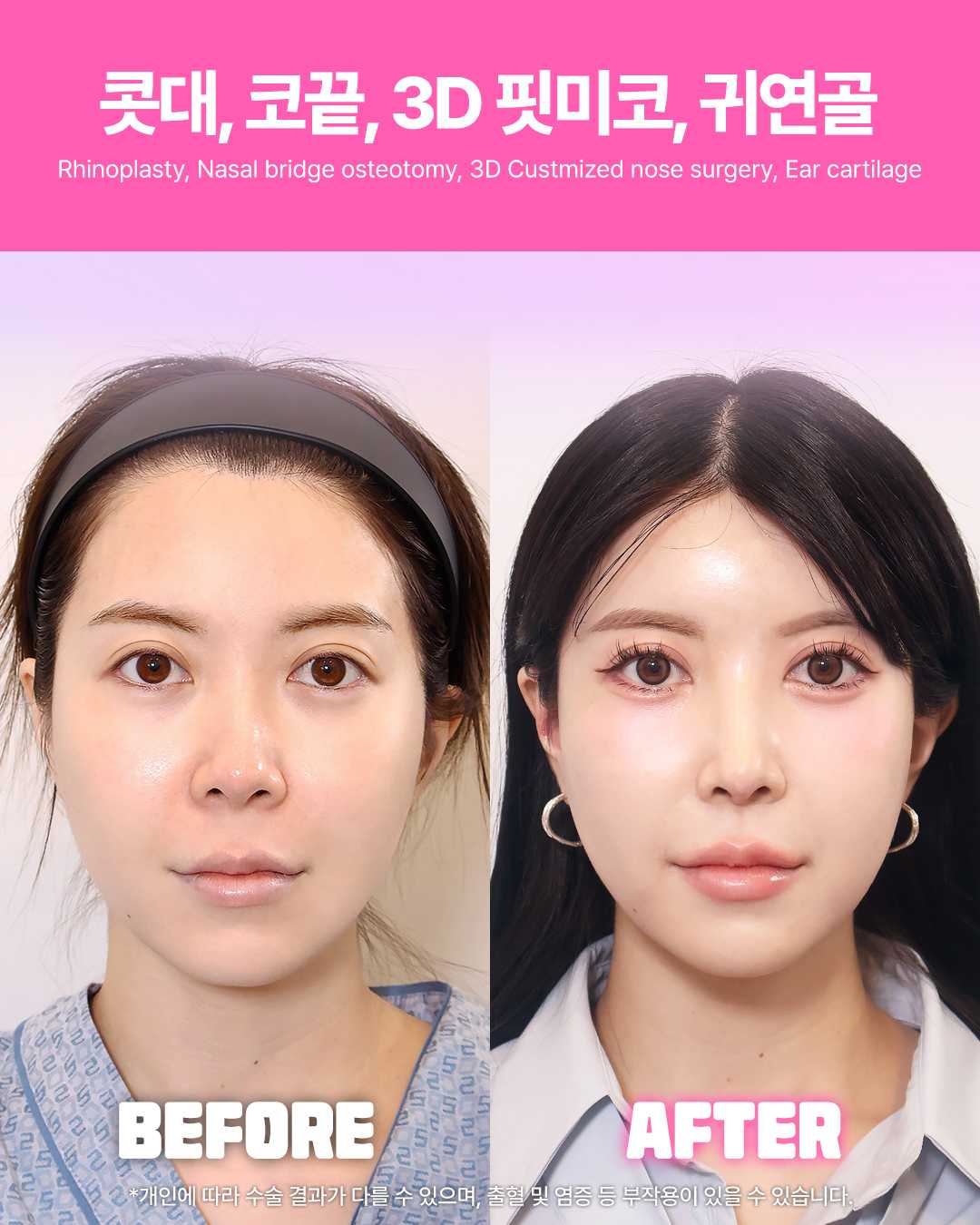 Returning Plastic Surgery Before and After Image