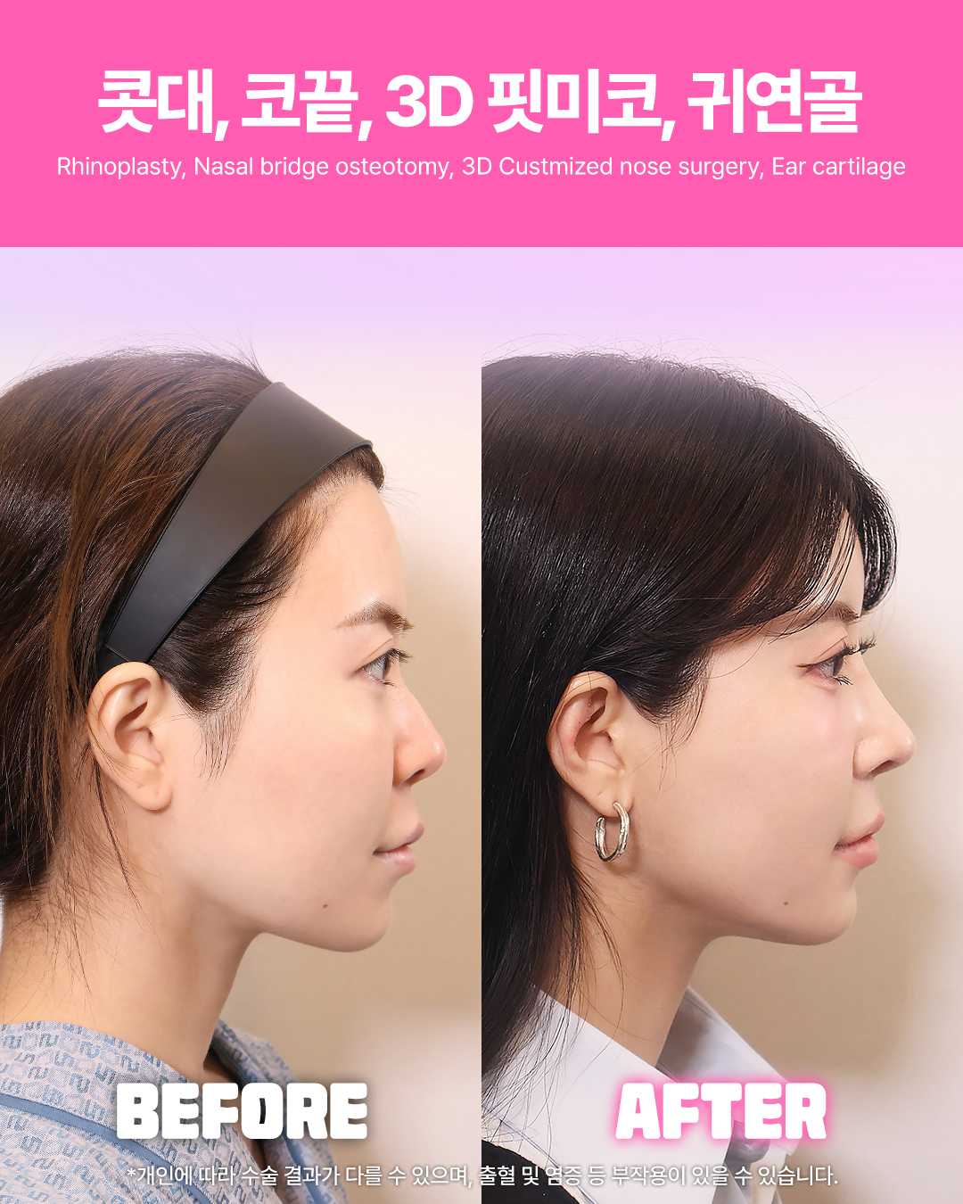 Returning Plastic Surgery Before and After Image Rhinoplasty