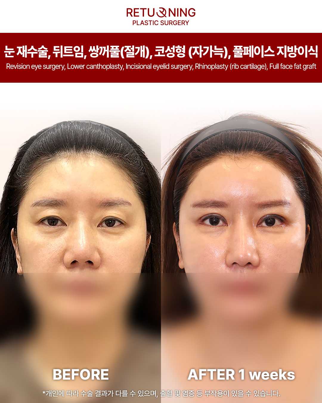 Returning Plastic Surgery Rhinoplasty Before and After Image