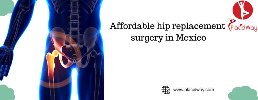 Why Mexico is a Top Destination for Hip Replacement Surgery