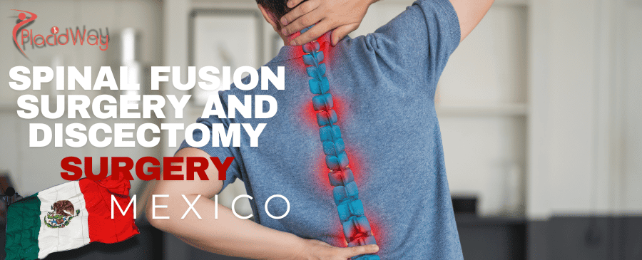 Avoid Long Wait Times for Spinal Fusion Surgery and Discectomy: Choose Mexico