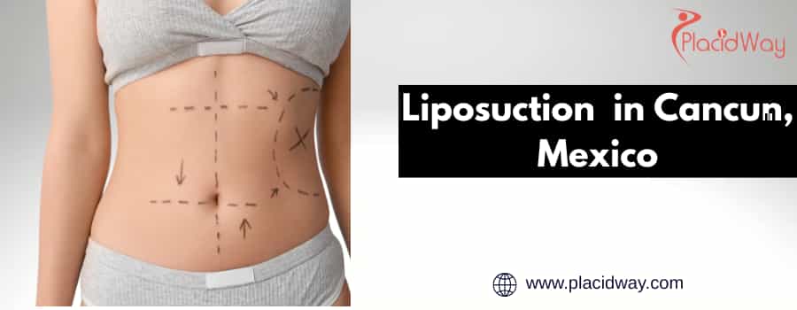 Liposuction Prices in Cancun, Mexico