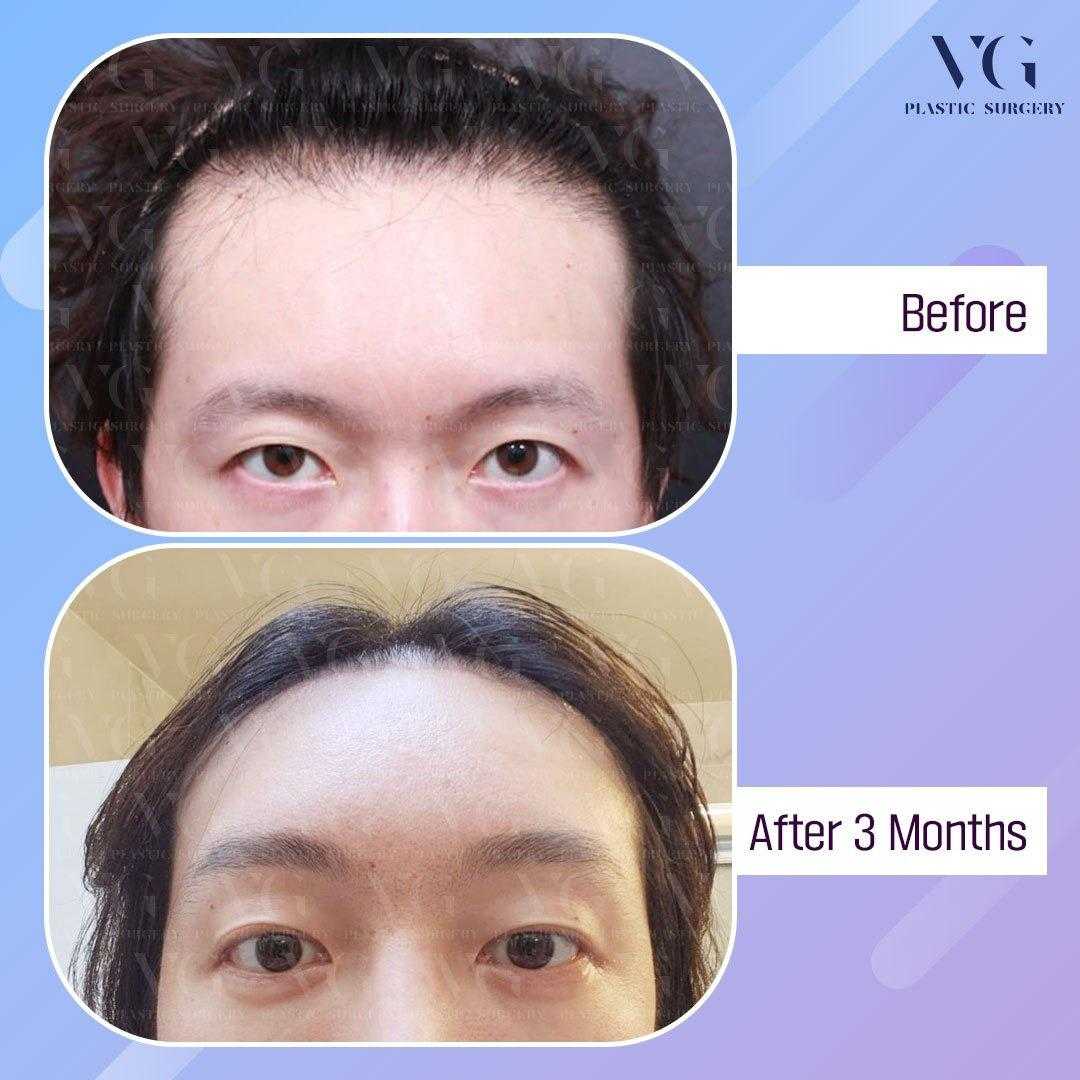 Before and After Forehead Reduction in Seoul South Korea