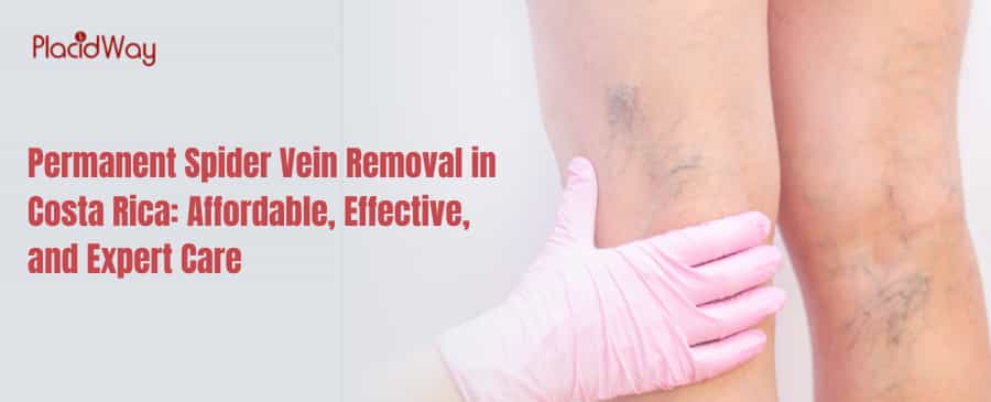 Permanent Spider Vein Removal in Costa Rica: Affordable, Effective, and Expert Care