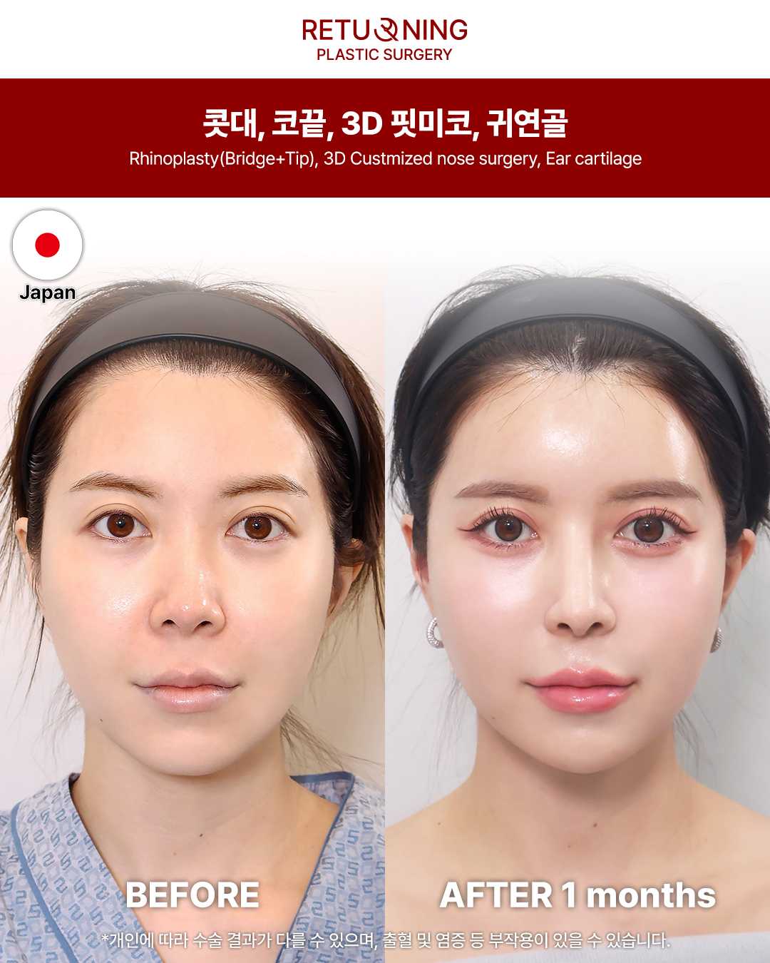 鼻部手术前后图片