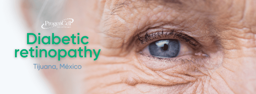 Diabetes Ojos