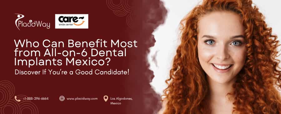 Who Can Benefit Most from All-on-6 Dental Implants Mexico? Discover If You’re a Good Candidate