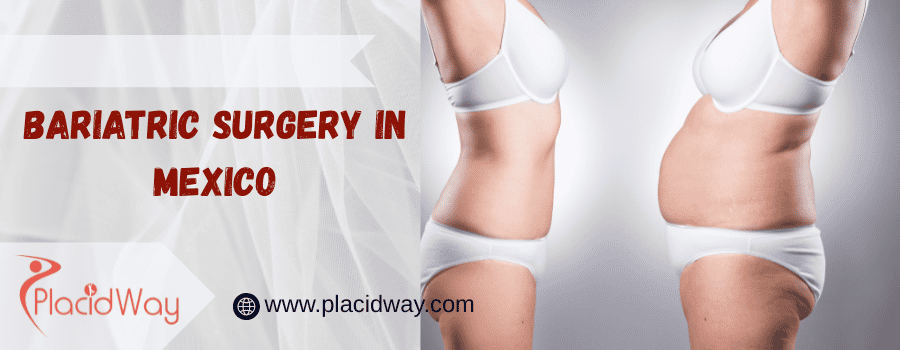 bariatric surgery in Mexico