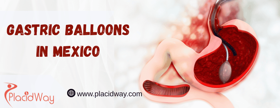 gastric balloons in Mexico