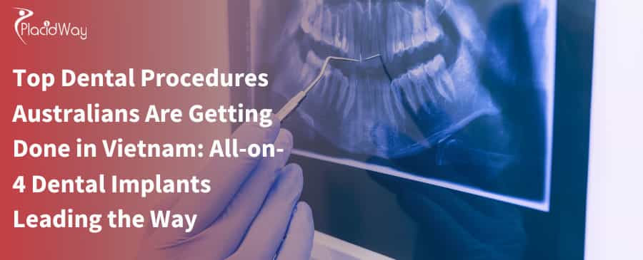 Top Dental Procedures Australians Are Getting Done in Vietnam: All-on-4 Dental Implants Leading the Way