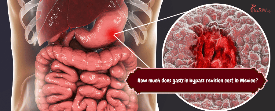 gastric bypass revision cost in Mexico
