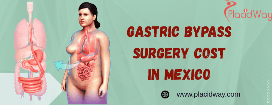 gastric bypass surgery cost in Mexico