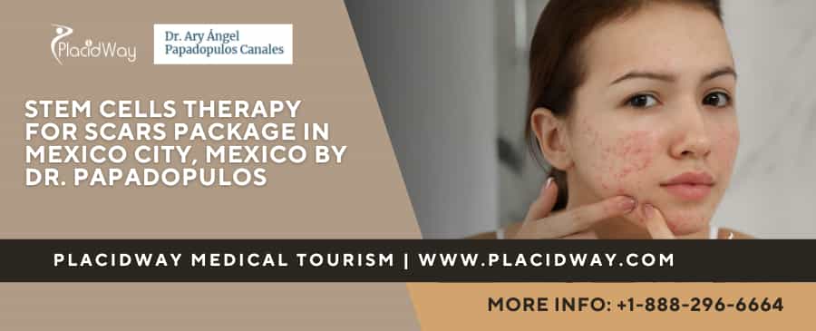 Stem Cells Therapy for Scars Cost in Mexico