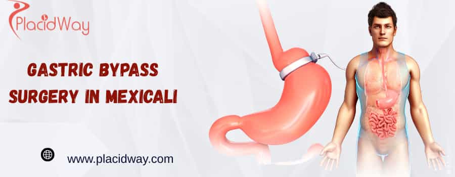 gastric bypass surgery in Mexicali