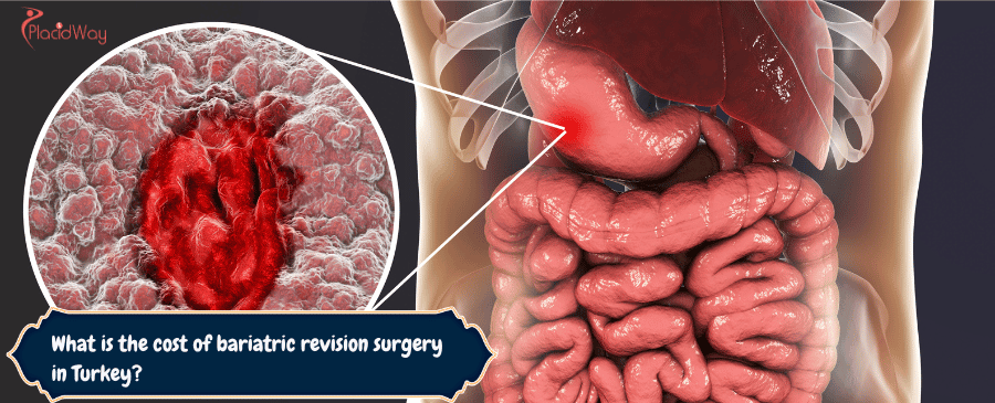 bariatric revision surgery in Turkey