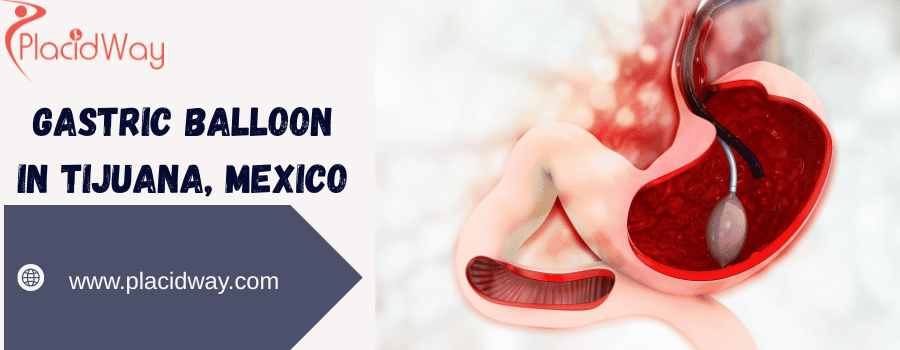 gastric balloon procedure in Tijuana, Mexico