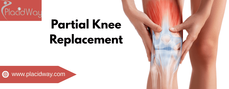 partial knee replacement