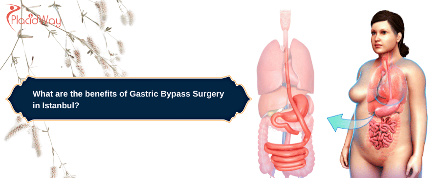 benefits of Gastric Bypass Surgery in Istanbul