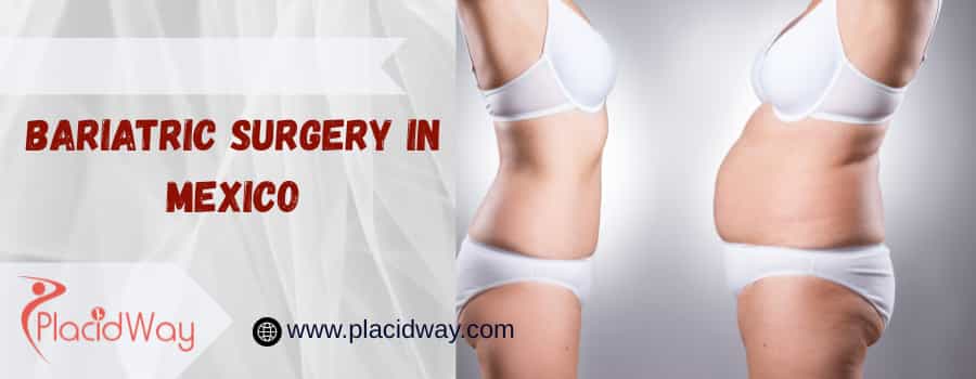 bariatric surgery in Mexico