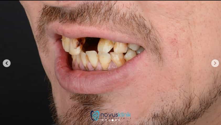 Before treatment