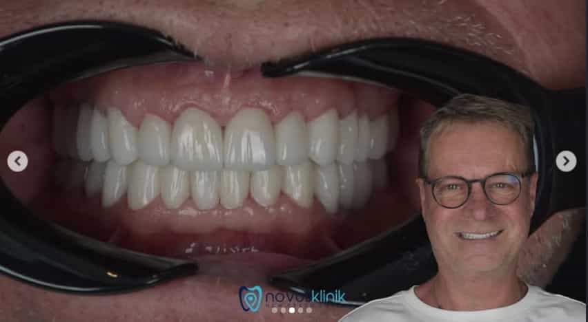 After Treatment