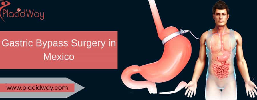 Gastric Bypass Surgery In Mexico