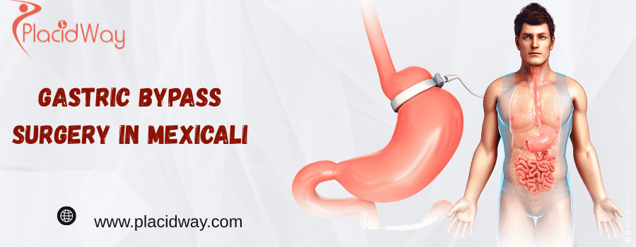 bypass surgery in Mexicali