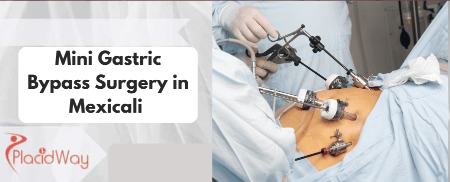 Mini Gastric Bypass Surgery in Mexicali