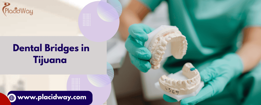  Dental Bridges in Tijuana
