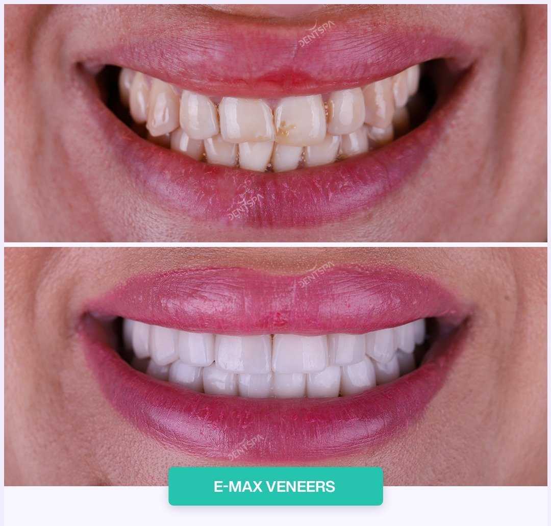 Antes y después de las carillas dentales en Estambul, Turquía