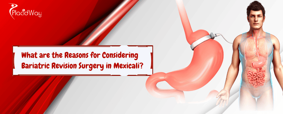 bariatric revision surgery in Mexicali