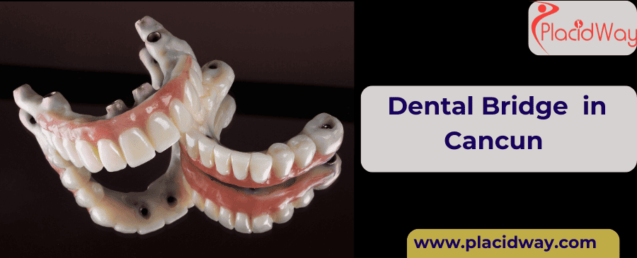 Dental Bridge in Cancun