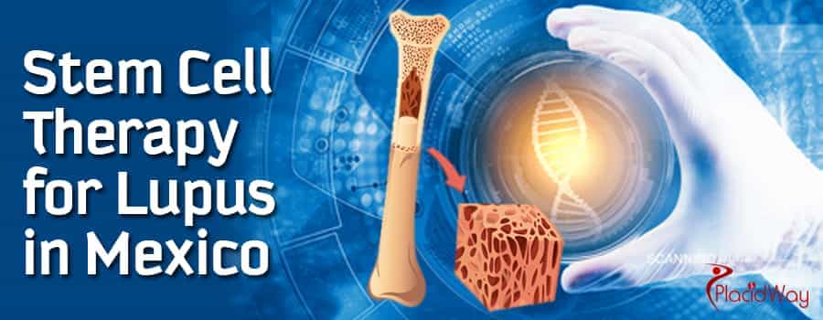 stem cell therapy for Lupus in Mexico