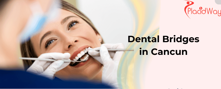 Dental Bridges in Cancun