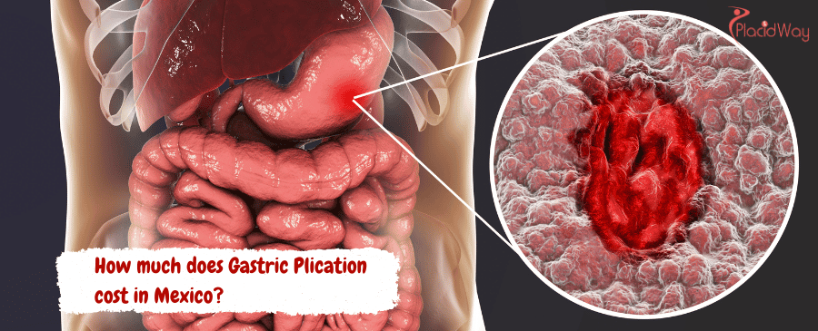 Gastric Plication cost in Mexico