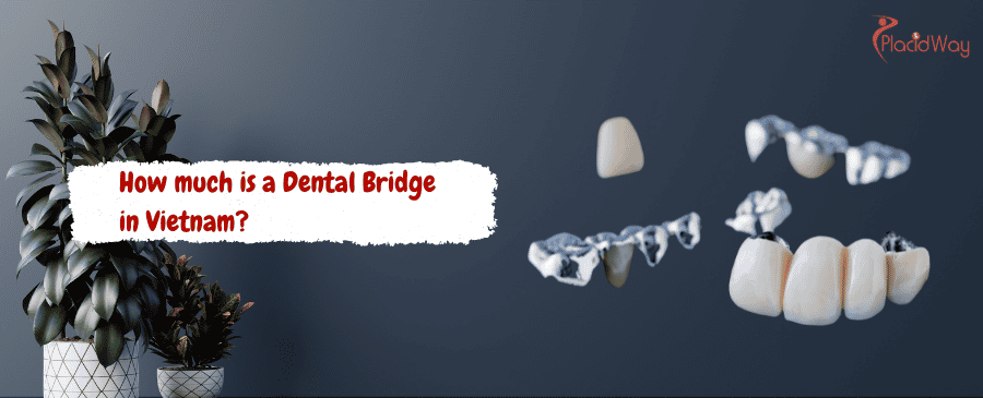 Dental Bridge in Vietnam