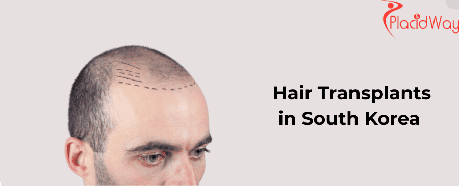 Hair Transplants in South Korea
