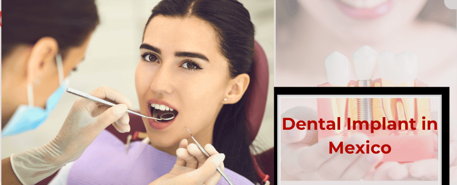 Dental Implant in Mexico