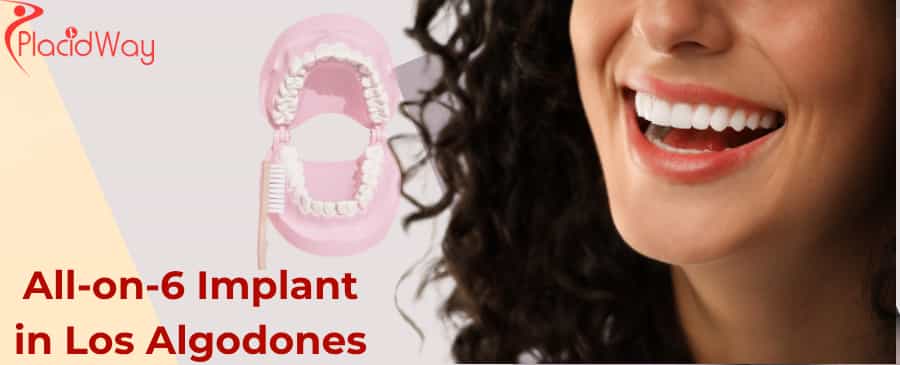 Implante All-on-6 en Los Algodones
