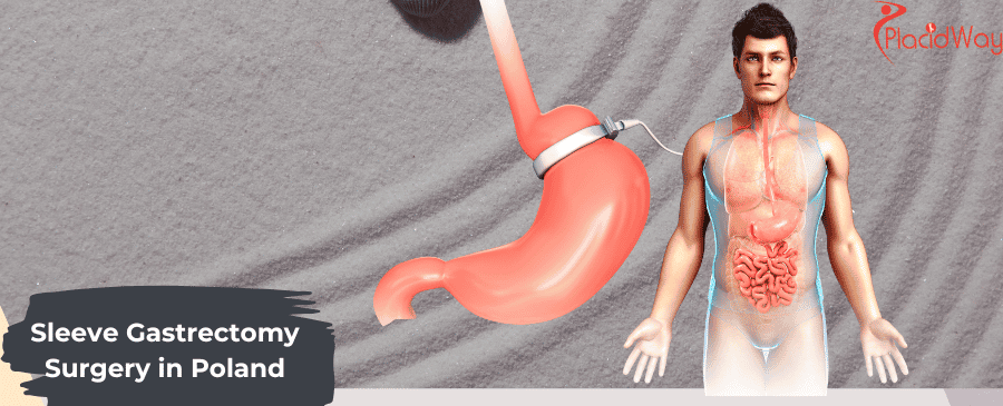 Sleeve Gastrectomy Surgery in Poland