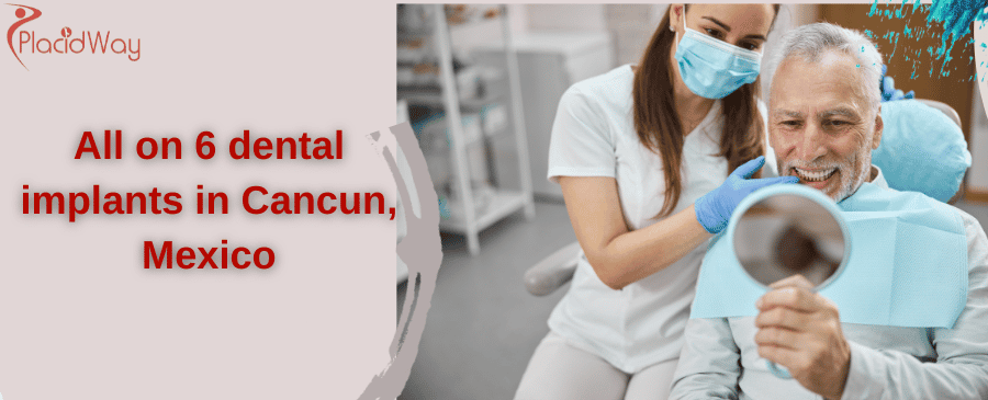 All on 6 dental implants in Cancun, Mexico