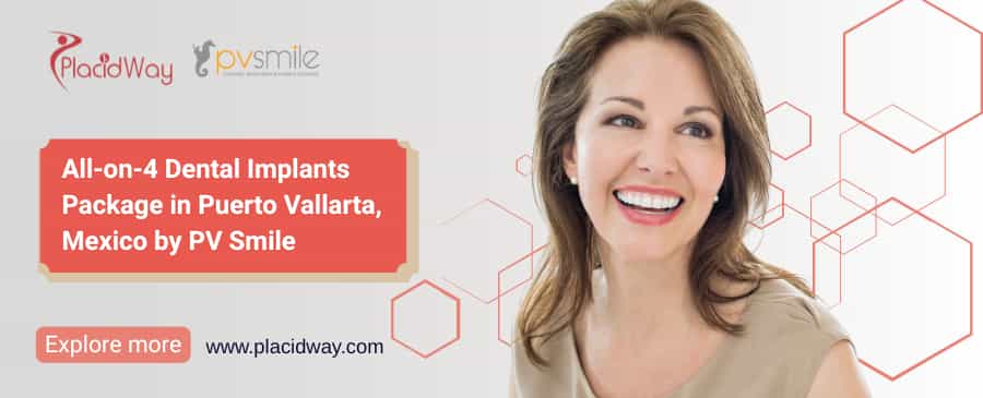 Dental Implants Puerto Vallarta All-on-4 Deal PV Smile