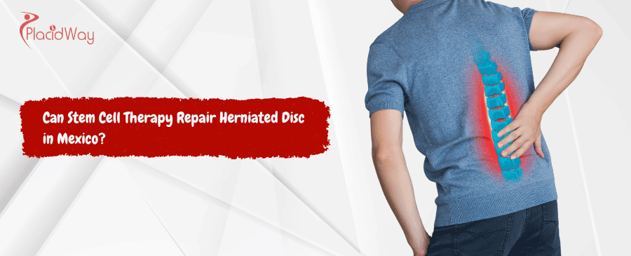 Stem Cell Therapy Repair Herniated Disc in Mexico
