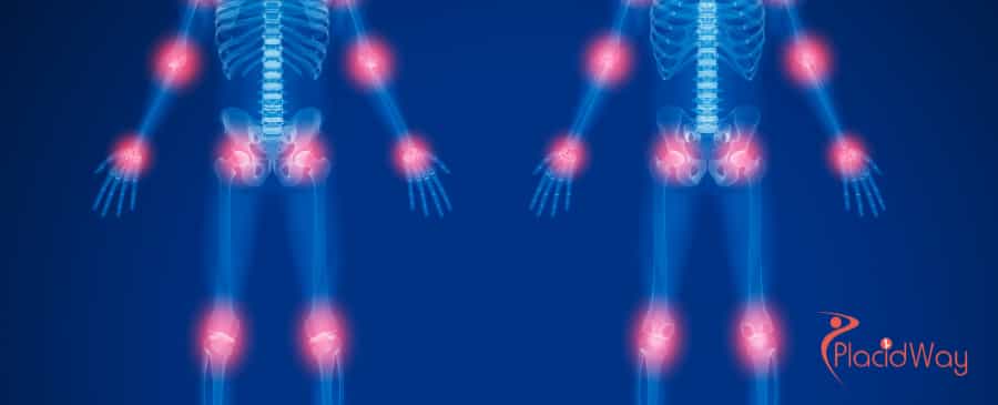 Terapia con células madre en México