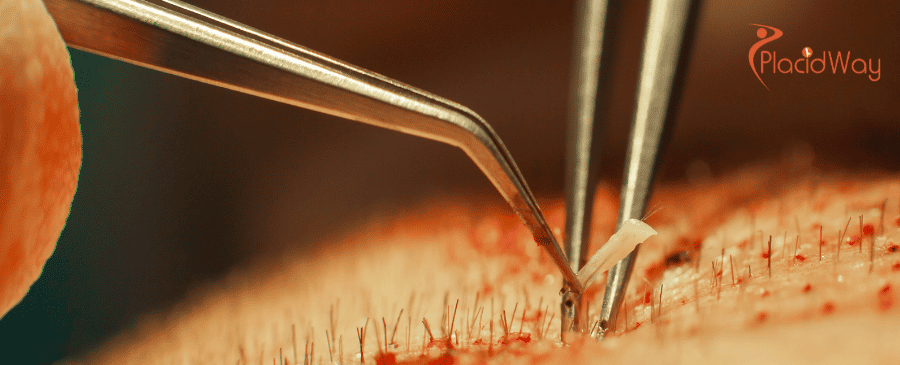 Hair Transplant in Turkey