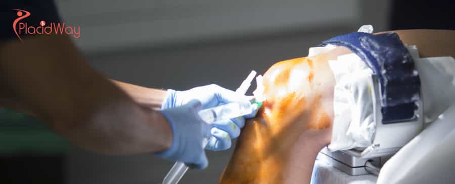 knee replacement surgery in Turkey