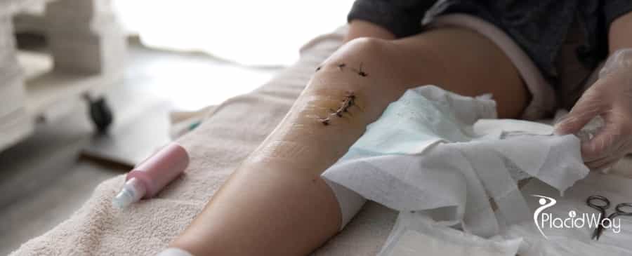 knee replacement surgery in Turkey