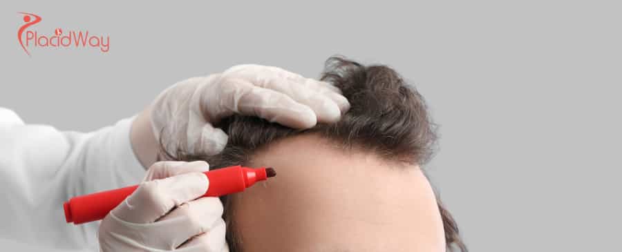 Hair Transplant in Turkey